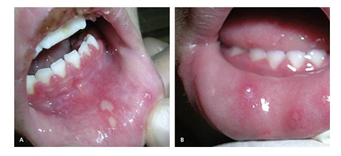 A and B show herpetiform presentation of HSV 1.